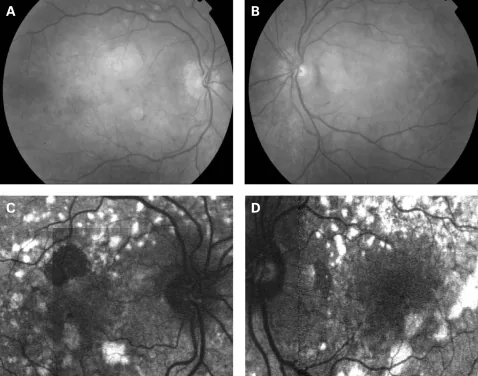 Glycogen Storage Disease Type V - McArdle Disease image