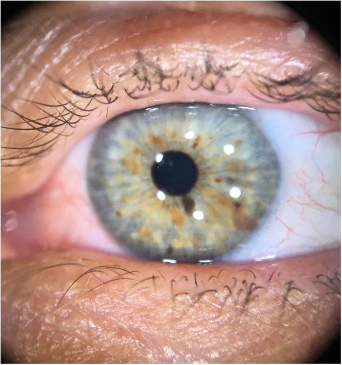 神経線維腫症1型の患者の眼の拡大写真。青緑色の虹彩の上に、黄褐色から茶色の小さな盛り上がり(Lisch結節)が多数散在している。