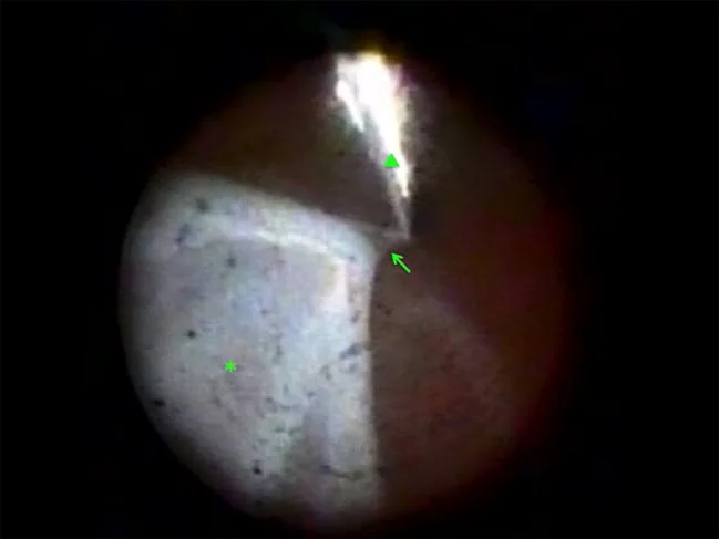 Distacco della membrana proliferativa nella vitreoretinopatia proliferativa