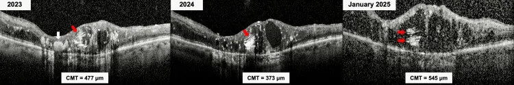 OCT macular edema in radiation retinopathy