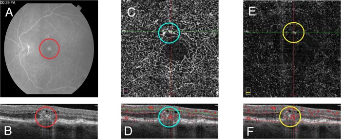 Multimodale Bildgebung der retinalen angiomatösen Proliferation