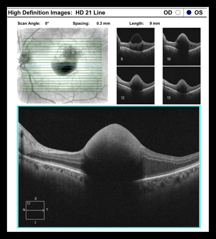 Edinsel retinal arteriyel mikroanevrizmanın OCT görüntüsü