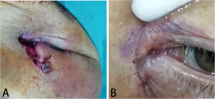 تصاویر پیش از عمل و پس از عملِ پارگی کانال اشکی و پارگی پلک