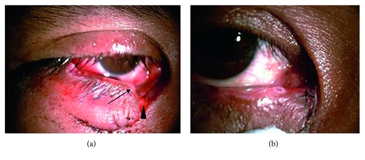 Canalicular laceration preoperative photograph