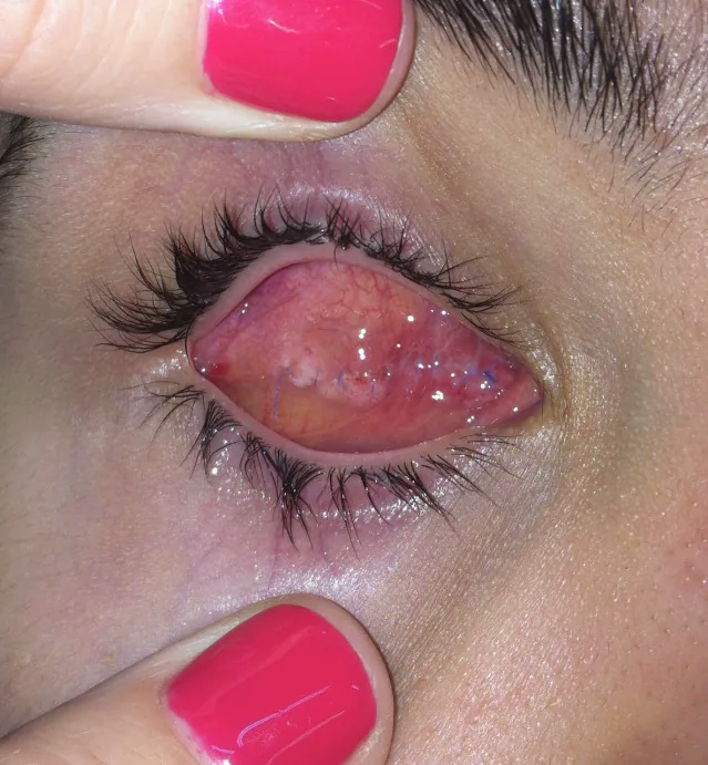 眼球摘出後の眼窩インプラントと結膜面の術後写真