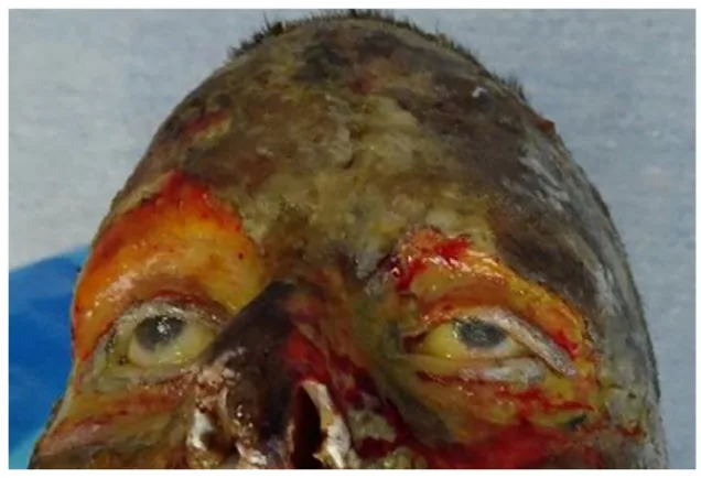 Eyelid burns clinical photograph