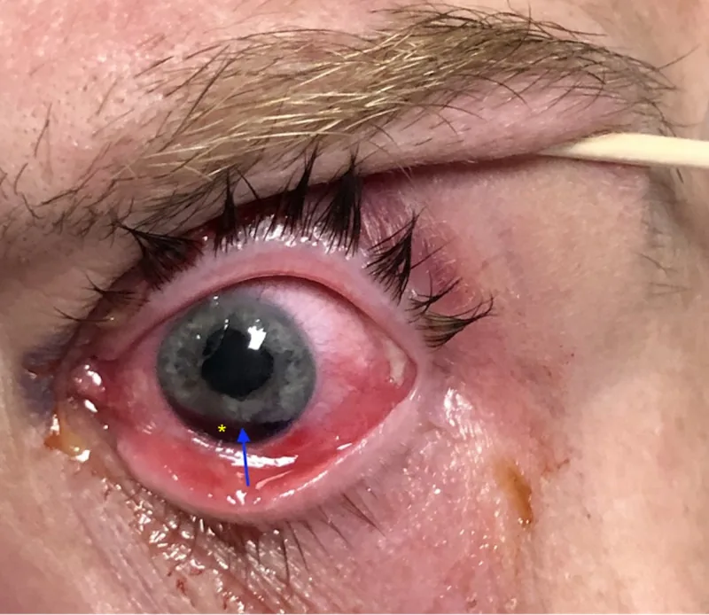 外傷性虹彩根部離断と前房出血（前眼部写真）