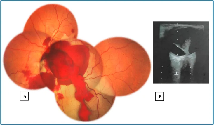 Optic nerve head avulsion initial images