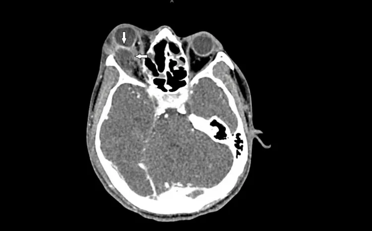 Immagine TC di deformazione del bulbo oculare e compressione del nervo ottico dovute ad ascesso orbitario