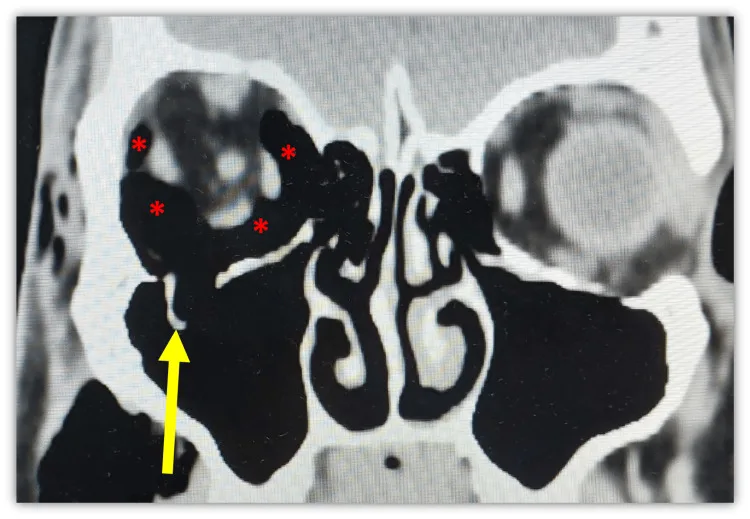眼窩気腫の冠状断CT。画像左（患者右）の眼窩上部に黒い空気の区域（赤アスタリスク）が複数あり、黄矢印の眼窩底に吹き抜け骨折がある。
