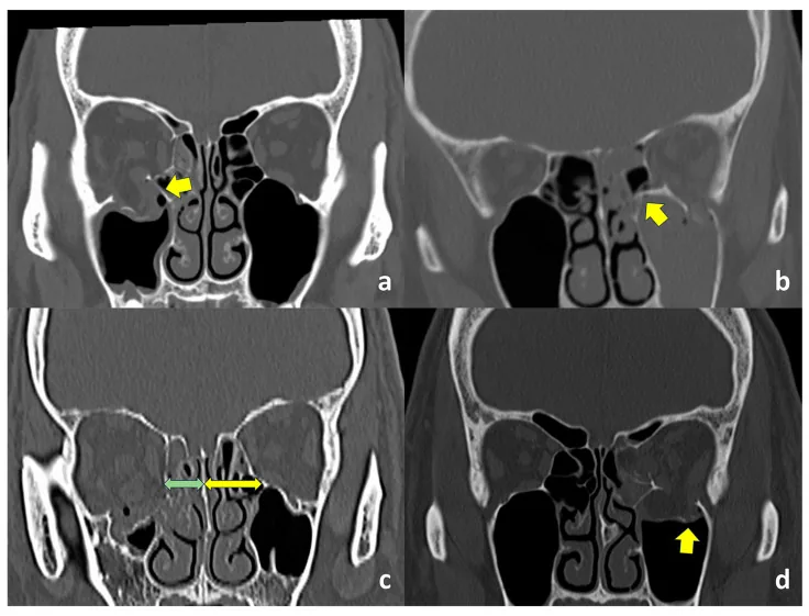 眼窩底骨折のCT画像。眼窩底や内側壁の骨折、および骨格の変形が示されている。