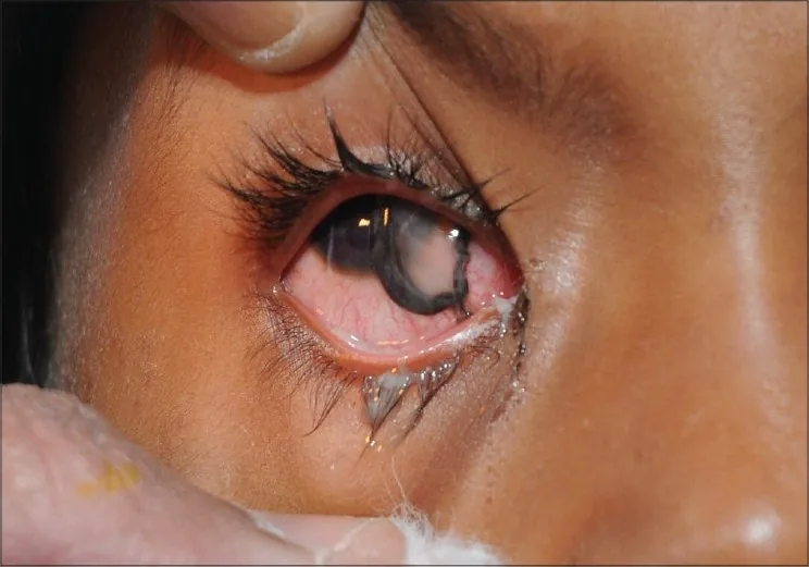 Open-globe firecracker injury clinical photograph