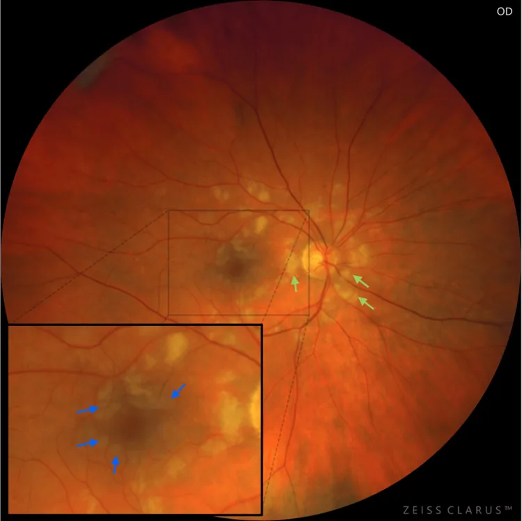 Fotografia del fondo oculare nella retinopatia di Purtscher: macchie di Purtscher e risparmio perivascolare