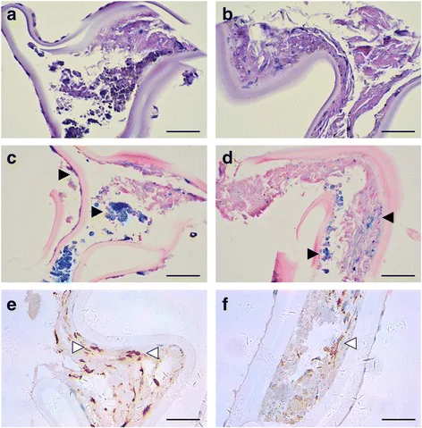 眼内鉄錆症（Siderosis bulbi）の水晶体前嚢組織病理像：ヘモジデリン沈着とプルシアンブルー鉄染色