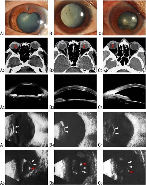 穿孔性外傷による水晶体混濁・眼内異物のCT・超音波所見