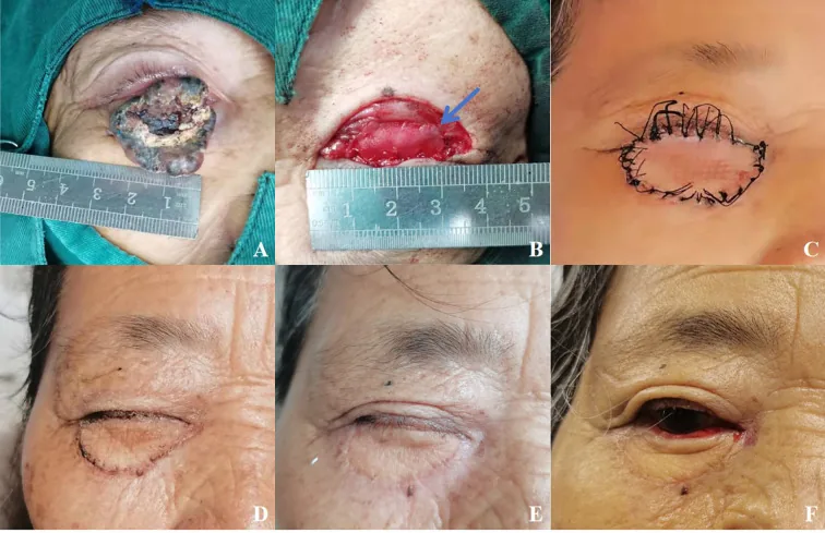 Carcinoma basocellulare dell'occhio destro e decorso dopo ricostruzione palpebrale
