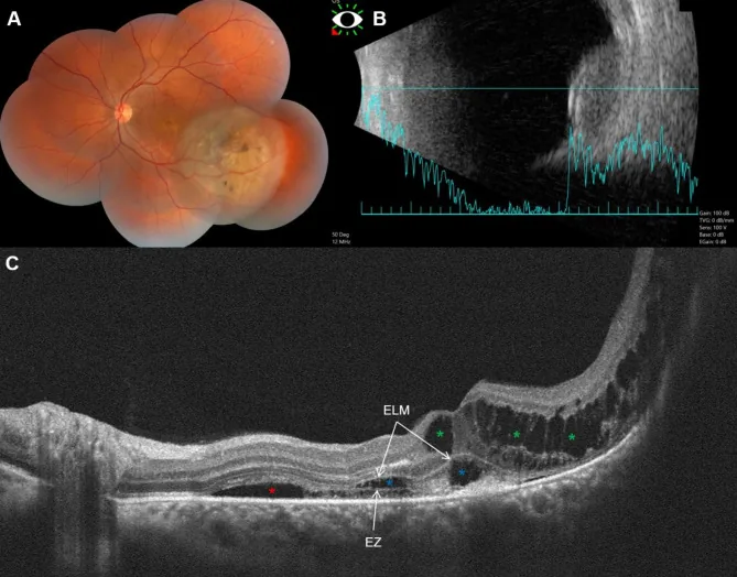 Koroid melanomunun fundus fotoğrafı, B-mod ultrason görüntüsü ve OCT görüntüsü