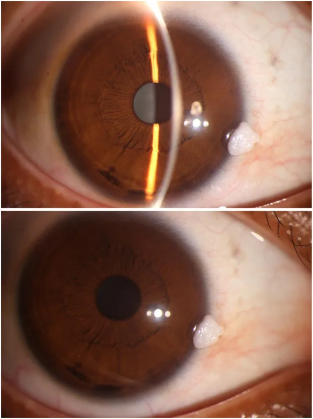 Conjunctival epithelial neoplasm slit-lamp photograph