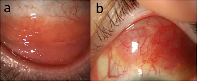 Conjunctival lymphoma clinical photograph