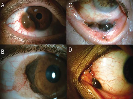 結膜メラノサイト系腫瘍の代表的な前眼部臨床写真
