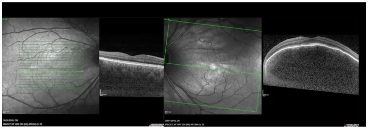 Hemangioma coroideu difuso na síndrome de Sturge-Weber: espessamento coroideu difuso bilateral na EDI-OCT