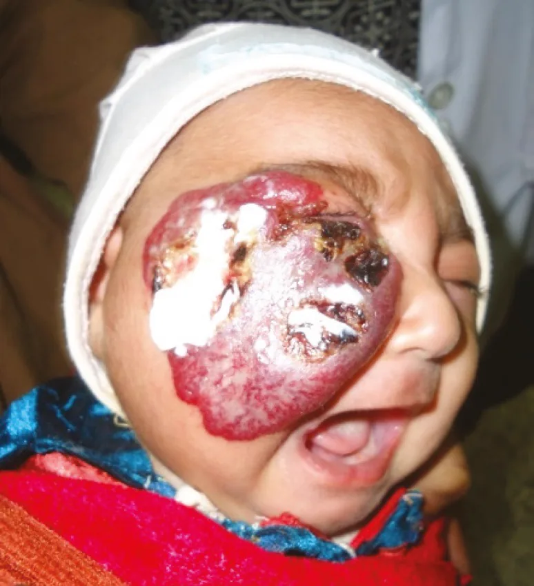 Hemangioma ในทารก (hemangioma สีสตรอเบอร์รี่) ที่หนังตาขวาและแก้มขวา: รอยโรคแดงนูนขนาดใหญ่ปกคลุมหนังตาร่วมกับหนังตาตกจากกลไก