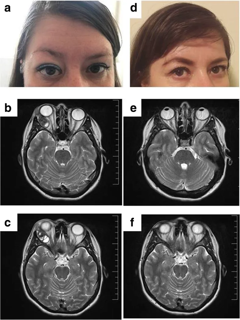 Lacrimal gland tumor with proptosis and MRI findings
