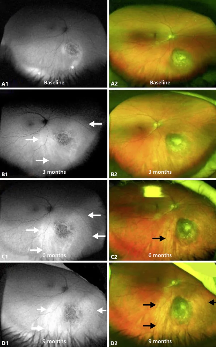 ¹⁰⁶Ruプラーク療法後の脈絡膜黒色腫周囲に生じたRPE萎縮と高自発蛍光の眼底写真および自発蛍光像