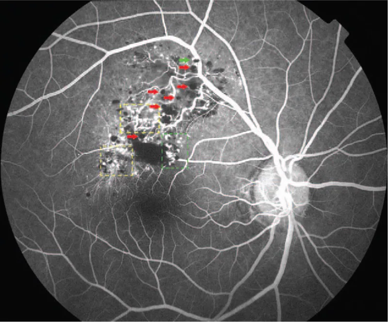 Fase venosa dell'angiografia retinica con fluoresceina di un emangioma cavernoso retinico (separazione plasma-eritrociti e segno del cappuccio fluorescente)