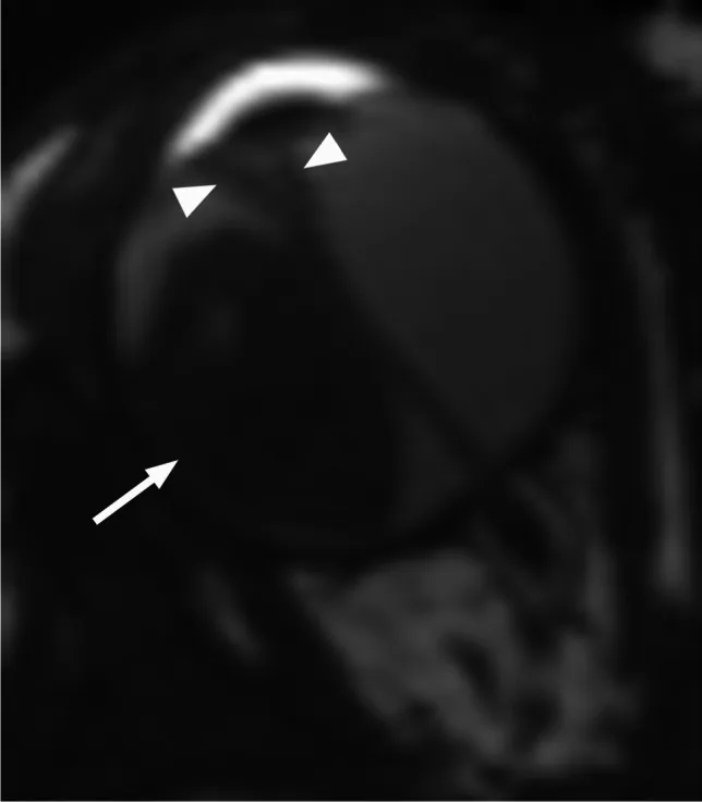 網膜芽細胞腫のMRI所見：外方増殖型と続発性網膜剥離