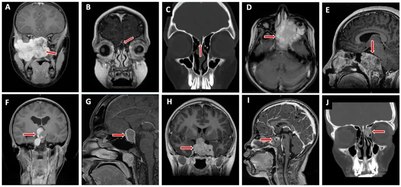 Immagine RM che mostra l'infiltrazione orbitaria e della base cranica da parte di un rabdomiosarcoma