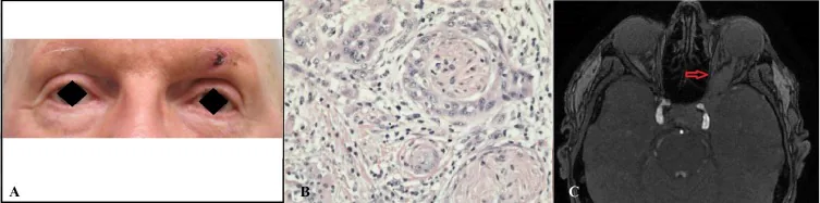 Klinisches Bild, histopathologische Befunde und MRT-Aufnahmen des Plattenepithelkarzinoms