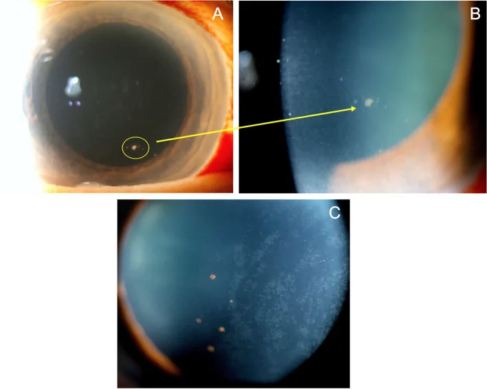 Fotografía con lámpara de hendidura de uveítis anterior por citomegalovirus. Se observan precipitados queráticos en forma de moneda en el endotelio corneal.