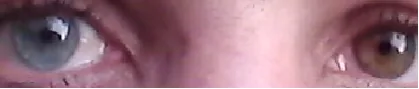Heterochromia iridis in Fuchs heterochromic iridocyclitis
