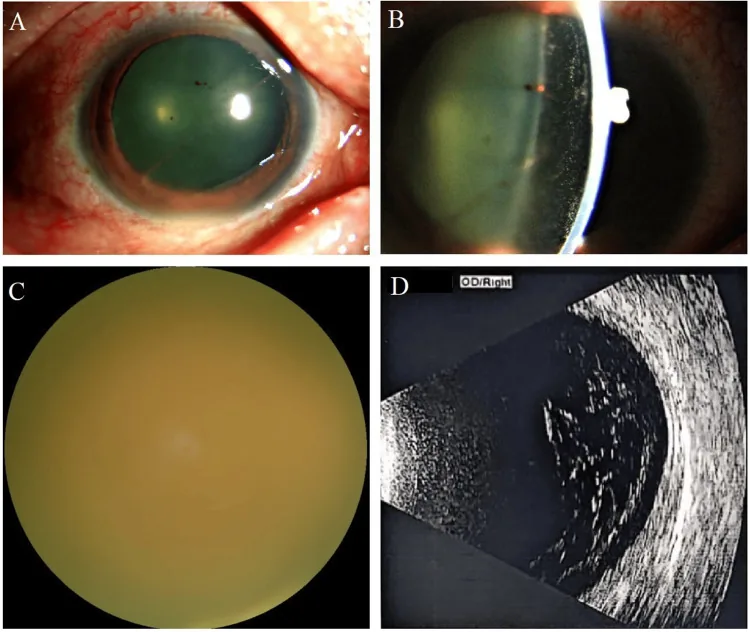 Fungal endoftalmitin klinik görüntüsü. Silier hiperemi, ön kamara inflamasyonu, vitreus bulanıklığı ve B-scan'de intravitreal bulanıklık gösterilmektedir