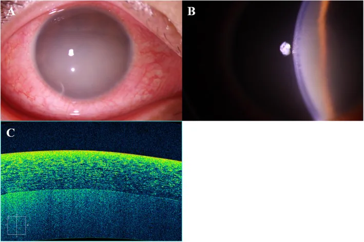Flare intenso na câmara anterior e hiperemia conjuntival na uveíte anterior aguda associada ao HLA-B27