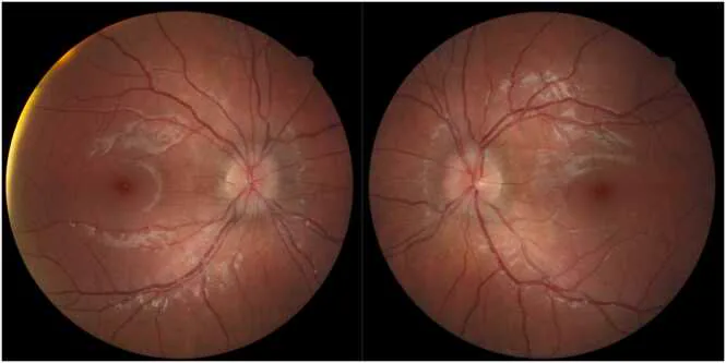 Edema bilateral de la papila óptica asociado a neuroborreliosis