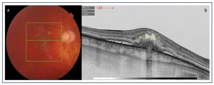 Fotografia de fundo de olho e OCT de coroidopatia puntiforme interna. Observam-se pequenas lesões no polo posterior, lesão hiperrefletiva na mácula e líquido sub-retiniano.